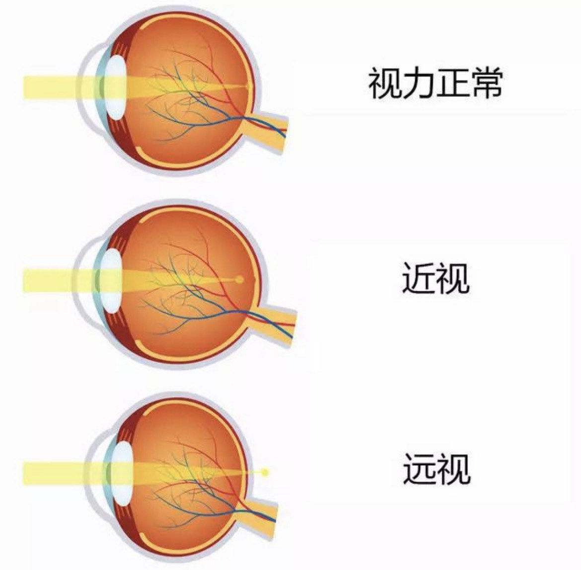 瞄准数亿级老视市场 云顶新耀拿下老花眼创新药LNZ100大中华区权益